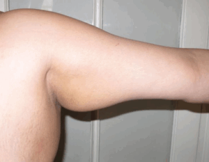 Chirurgie des bras