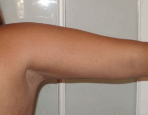 Chirurgie des bras