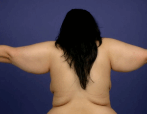 Chirurgie des bras
