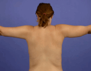Chirurgie des bras