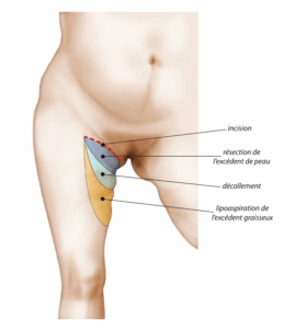 lifting-des-cuisses-1