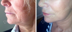 Avant - après - Génioplastie - Dr Seroussi