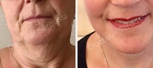 Avant - après - Génioplastie - Dr Seroussi