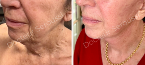 Avant - après - Génioplastie - Dr Seroussi