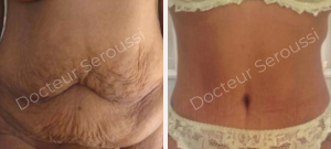 Avant - Après - Silhouette - ventre