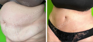 Avant - Après - Silhouette - ventre