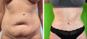 Avant - Après - Silhouette - ventre