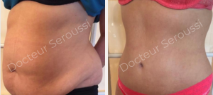 Avant - Après - Silhouette - ventre