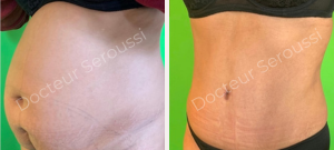 Avant - Après - Silhouette - ventre