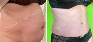 Avant - Après - Silhouette - ventre