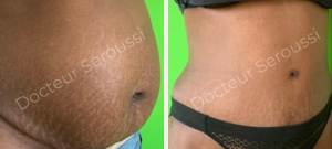 Avant - Après - Silhouette - ventre