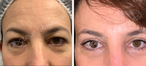 avant-après - paupières - Dr Seroussi