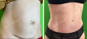 Avant - Après - Silhouette - ventre