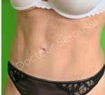 Avant - Après - Silhouette - ventre