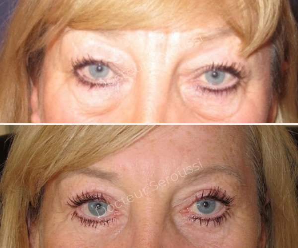 Avant - après - Paupières - Dr Seroussi
