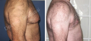 avant-après - Gynécomastie - Dr Seroussi