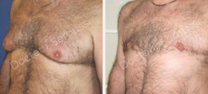 avant-après - Gynécomastie - Dr Seroussi