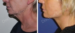 avant - après - Lifting cervico facial - Dr Seroussi