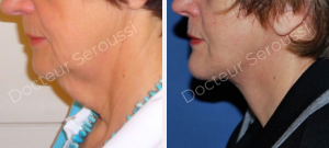 avant - après - Lifting cervico facial - Dr Seroussi