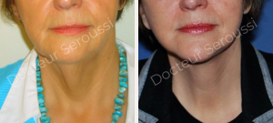 avant - après - Lifting cervico facial - Dr Seroussi