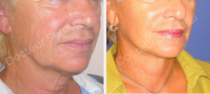 avant - après - Lifting cervico facial - Dr Seroussi