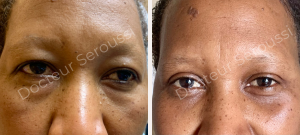 Avant-Après - Visage - Dr Seroussi