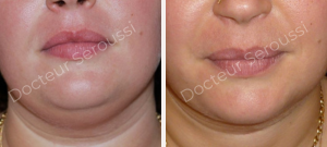 avant - après - Lifting cervico facial - Dr Seroussi