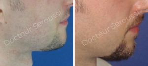 avant - après - Lifting cervico facial - Dr Seroussi