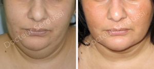 avant - après - Lifting cervico facial - Dr Seroussi
