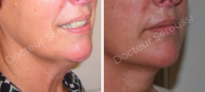 avant - après - Lifting cervico facial - Dr Seroussi