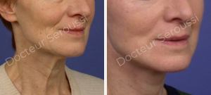 avant - après - Lifting cervico facial - Dr Seroussi