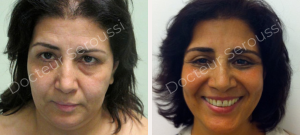 avant - après - Lifting cervico facial - Dr Seroussi
