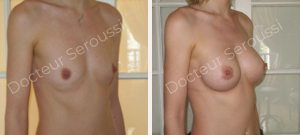 Avant-après - prothèse mammaire - Dr Seroussi