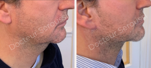 Avant - après - Génioplastie - Dr Seroussi