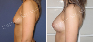 Avant-après - prothèse mammaire - Dr Seroussi