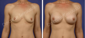 Avant-après - prothèse mammaire - Dr Seroussi