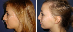 Avant-après - Rhinoplastie - Dr Seroussi