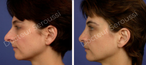 Avant-après - Rhinoplastie - Dr Seroussi