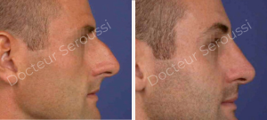Avant-après - Rhinoplastie - Dr Seroussi