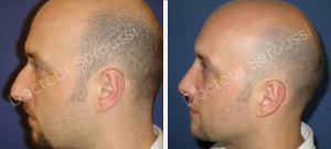 Avant-après - Rhinoplastie - Dr Seroussi