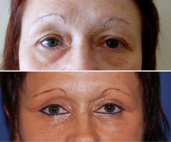 Avant - après - Paupières - Dr Seroussi