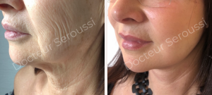 Avant - après - Génioplastie - Dr Seroussi