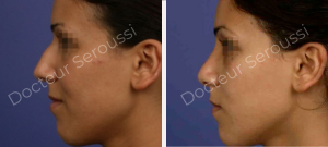 Avant-après - Rhinoplastie - Dr Seroussi