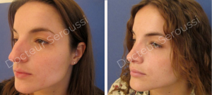 Avant-après - Rhinoplastie - Dr Seroussi