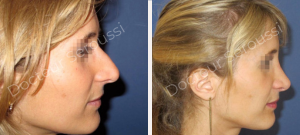 Avant-après - Rhinoplastie - Dr Seroussi