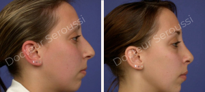 Avant-après - Rhinoplastie - Dr Seroussi
