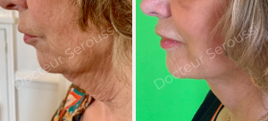 Avant - après - Génioplastie - Dr Seroussi