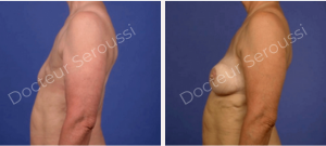 Avant-après - reconstruction mammaire - Dr Seroussi