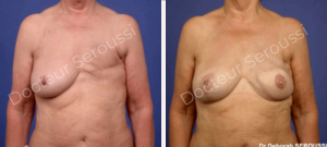 Avant-après - reconstruction mammaire - Dr Seroussi