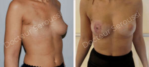 Avant-après - reconstruction mammaire - Dr Seroussi